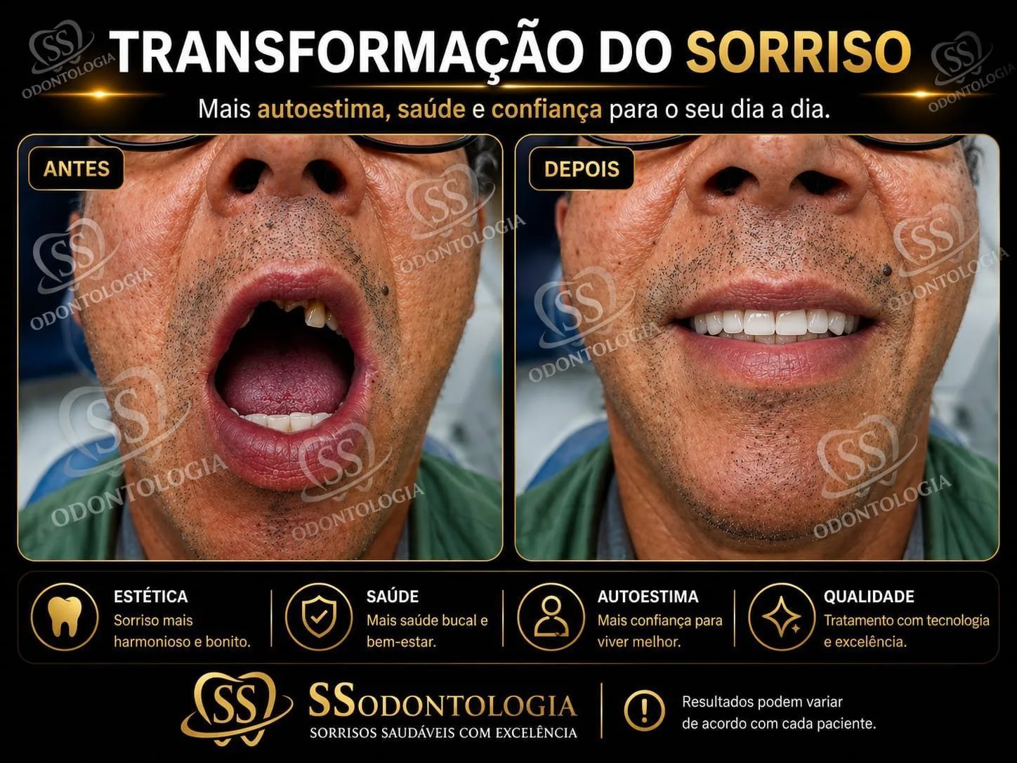 Antes e depois: Implantes e Prótese